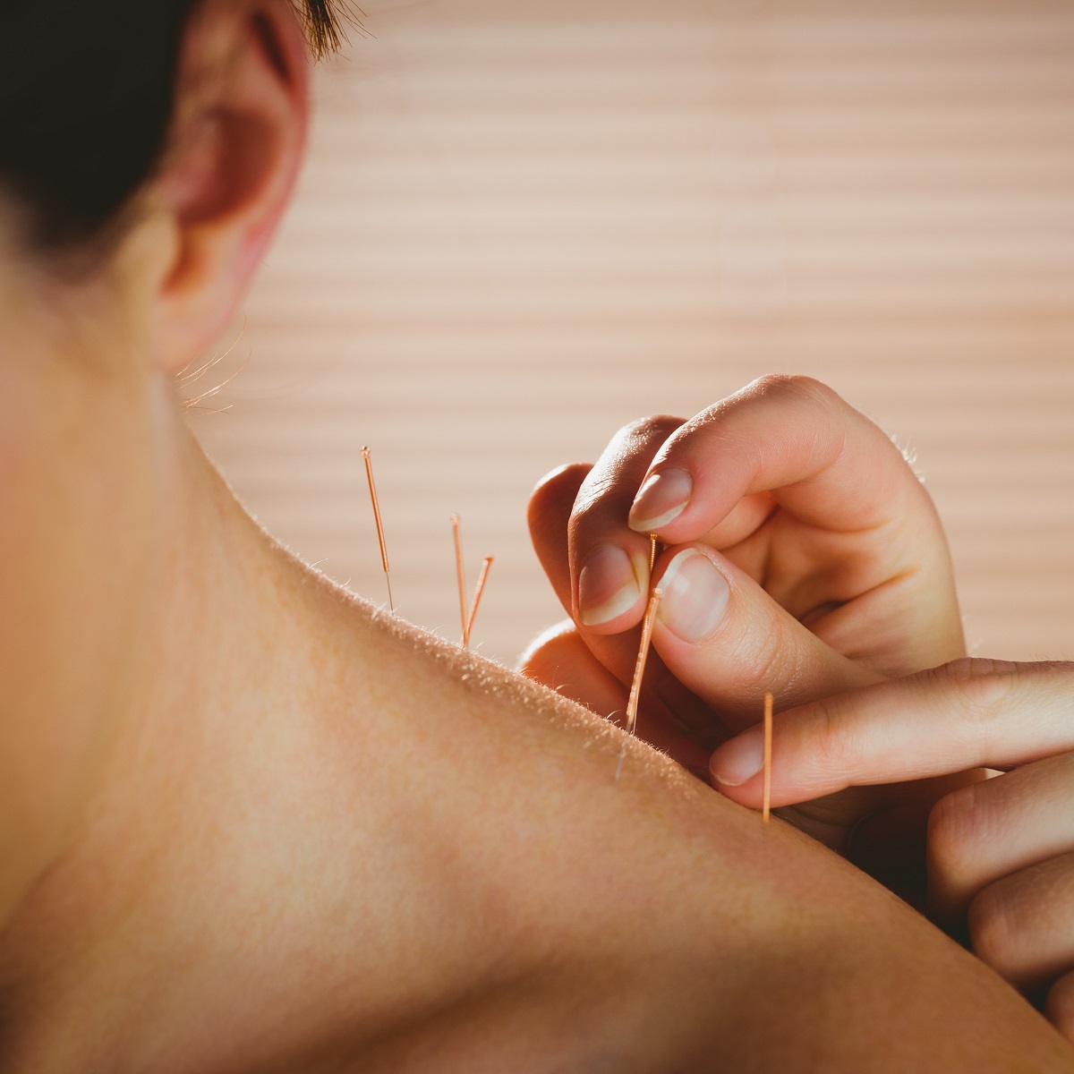 Mlada zena na terapiji Akupunkturom - Stavljanje iglica